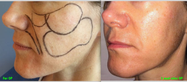 Steinbach pasient image005