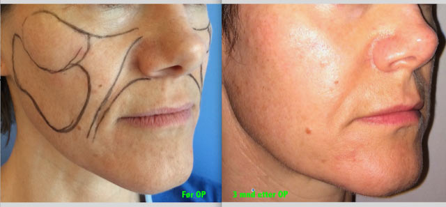 Steinbach pasient image007