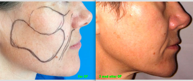 Steinbach pasient image008